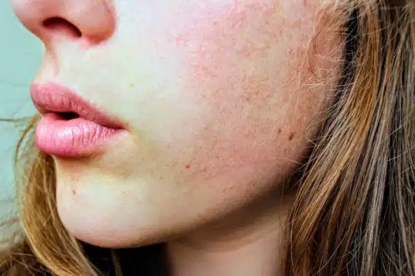 Les ingrédients à éviter dans les produits de beauté pour les peaux sensibles ou acnéiques