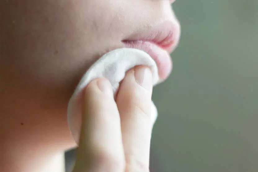 Comment se débarrasser de l’acné rapidement et naturellement ?